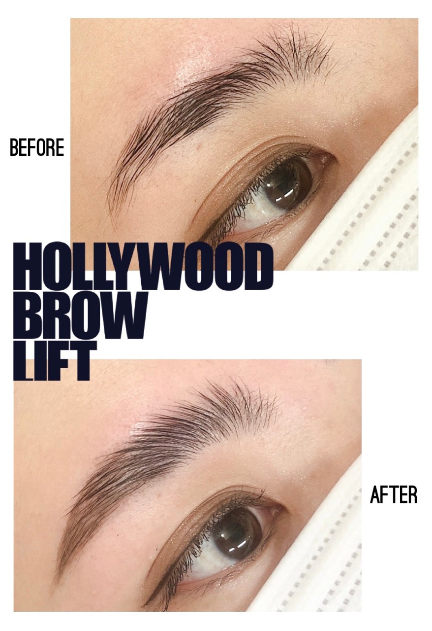 HOLLYWOOD BROW LIFT（ハリウッドブロウリフト）施術例